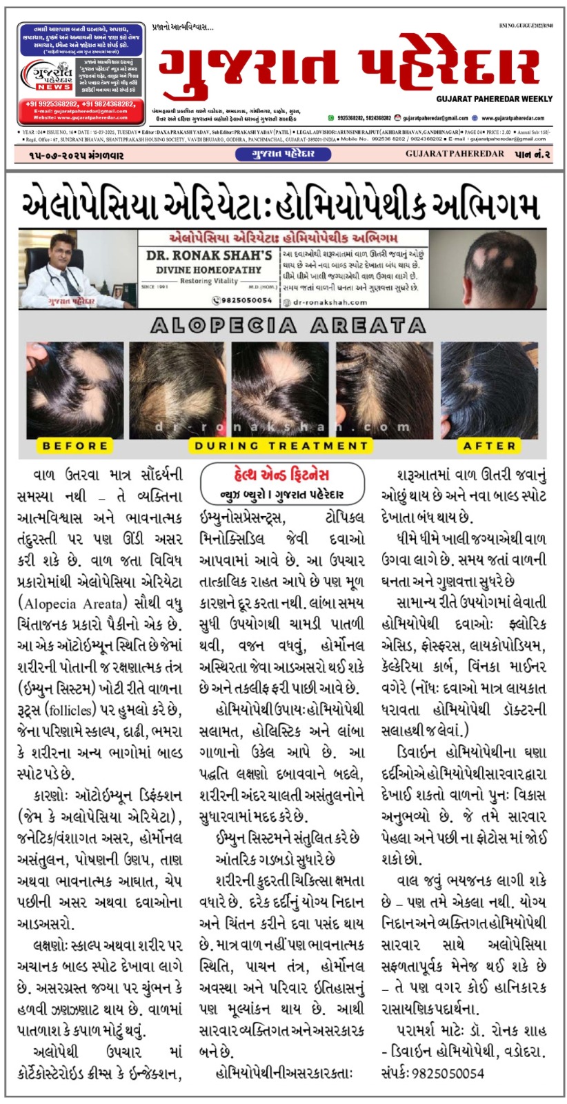 Alopecia